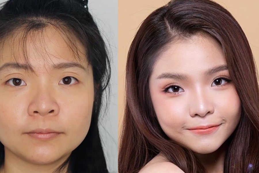 Những ai dưới 30 tuổi đang gặp các khuyết điểm mắt có thể cân nhắc để bấm mí mắt