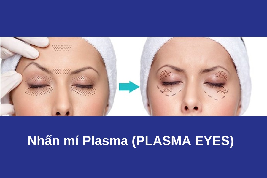 Đây là phương pháp tạo mắt 2 mí bằng thiết bị Plexr với tần số Plasma