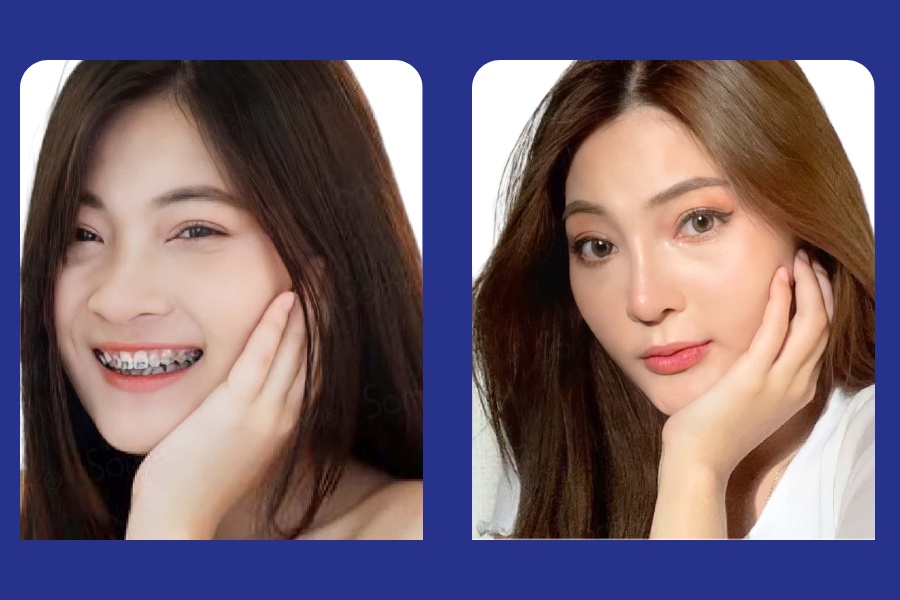 Thăng hạng nhan sắc ngay tức thì với đôi mắt 2 mí hoàn hảo cùng chị Đẹp Ngọc Dung