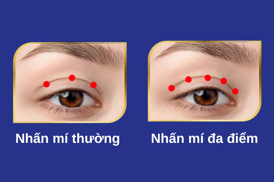 Thay vì chỉ tạo 3 điểm nhấn cố định, bấm mí đa điểm tạo nhiều điểm nhấn hơn