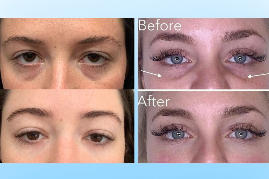 Những người có bọng mỡ mắt to, khiến đôi mắt trông mệt mỏi, thiếu sức sống nên thực hiện cắt mí dưới