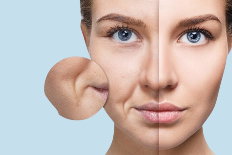 Người có rãnh cười sâu phù hợp thực hiện cấy mỡ rãnh cười