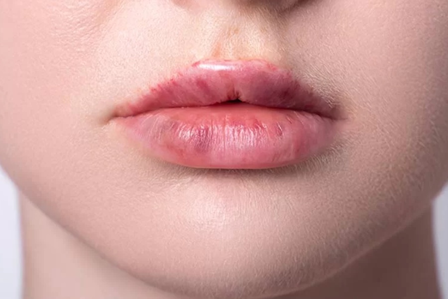 Môi sưng, bầm tím sau khi tiêm filler tại cơ sở thẩm mỹ không uy tín