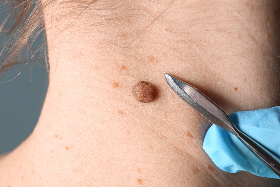 Tiểu phẫu cắt nốt ruồi