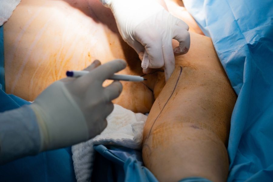 Phẫu thuật hút mỡ bắp tay