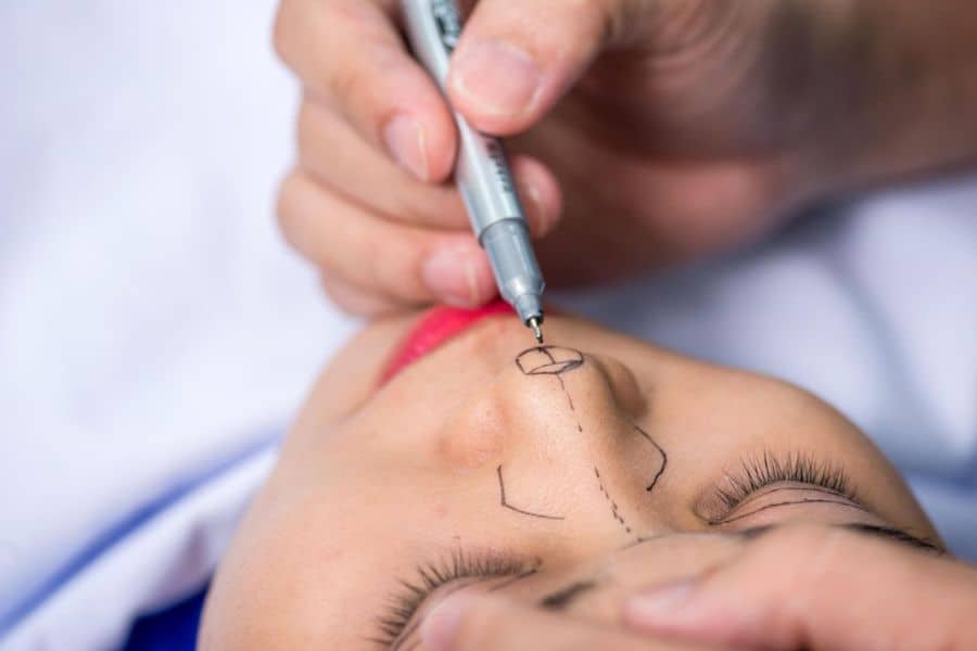 Nâng mũi tự thân Ngọc Dung: Thay dáng mũi, đổi vận mệnh 9 phẫu thuật nâng mũi bằng sụn tự thân