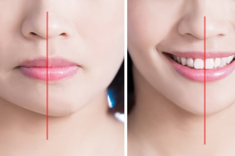 Hoàn toàn có thể rút sụn cằm sau phẫu thuật độn cằm