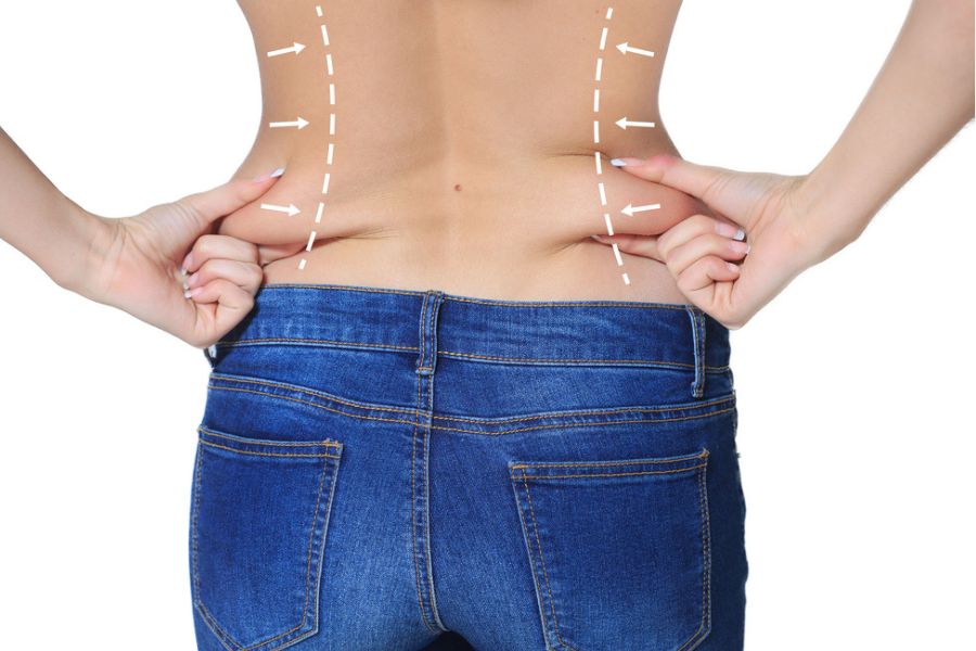 Thời gian hồi phục sau khi hút mỡ lưng ở mỗi người là khác nhau