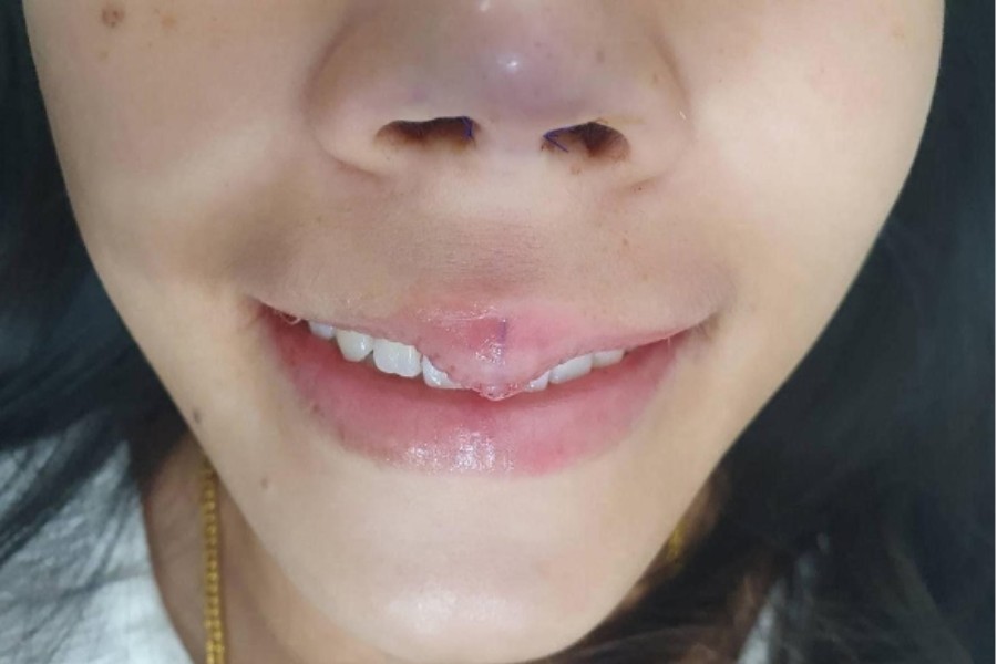 Môi hỏng lệch hoàn toàn có thể sửa chữa tại trung tâm thẩm mỹ uy tín