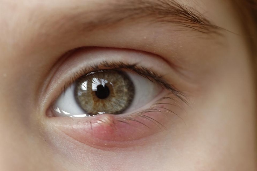 Mở góc mí cũng sẽ tiềm ẩn một số tác hại nếu không được thực hiện bởi bác sĩ tay nghề cao và tại cơ sở uy tín