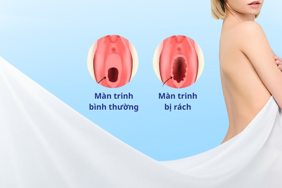 Mặc dù quan hệ tình dục là nguyên nhân phổ biến nhất, nhưng có nhiều yếu tố khác cũng có thể dẫn đến tình trạng màn trinh bị rách