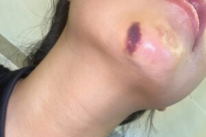 biến chứng sau độn cằm cần phải tháo miếng độn cằm