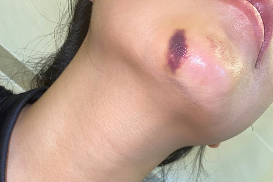 biến chứng sau độn cằm cần phải tháo miếng độn cằm