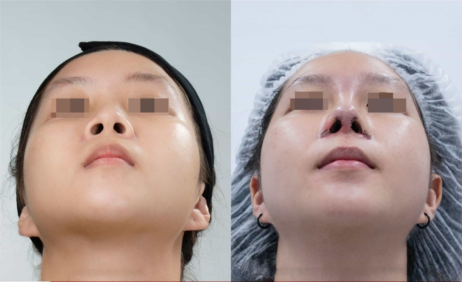 Images of successful alar base refinement of clients