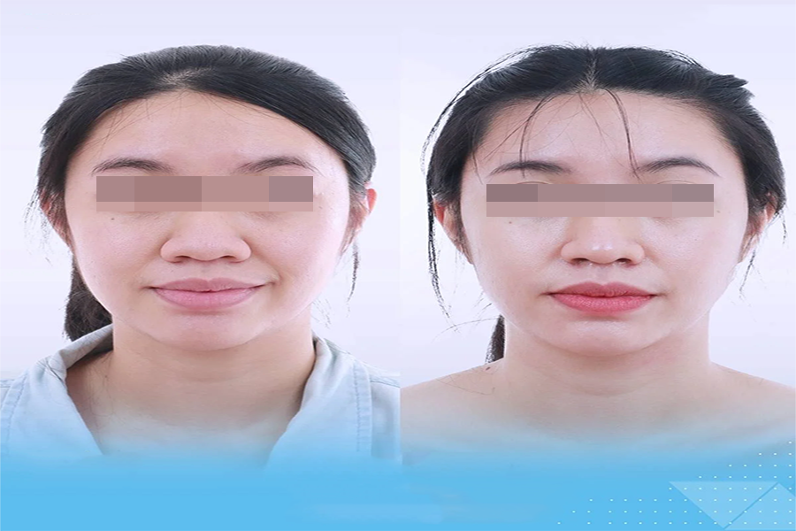 Images of successful alar base refinement of clients