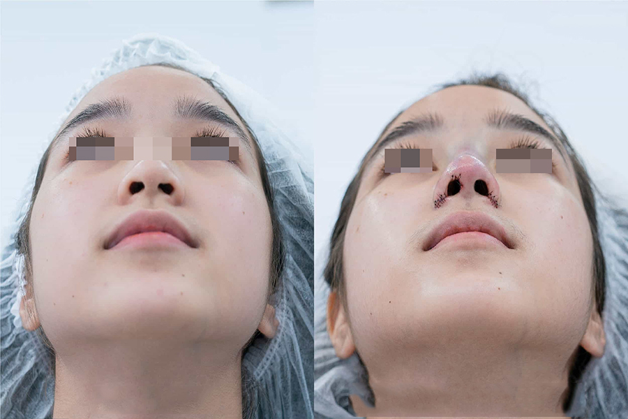 Alar base refinement at Ngoc Dung Aesthetic Hospital