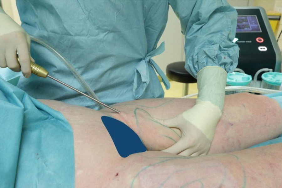 Bác sĩ sử dụng dụng cụ chuyên dụng để hút mỡ đùi