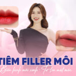 Tiêm filler môi là gì? 5 Điều cần biết trước và sau tiêm filler môi
