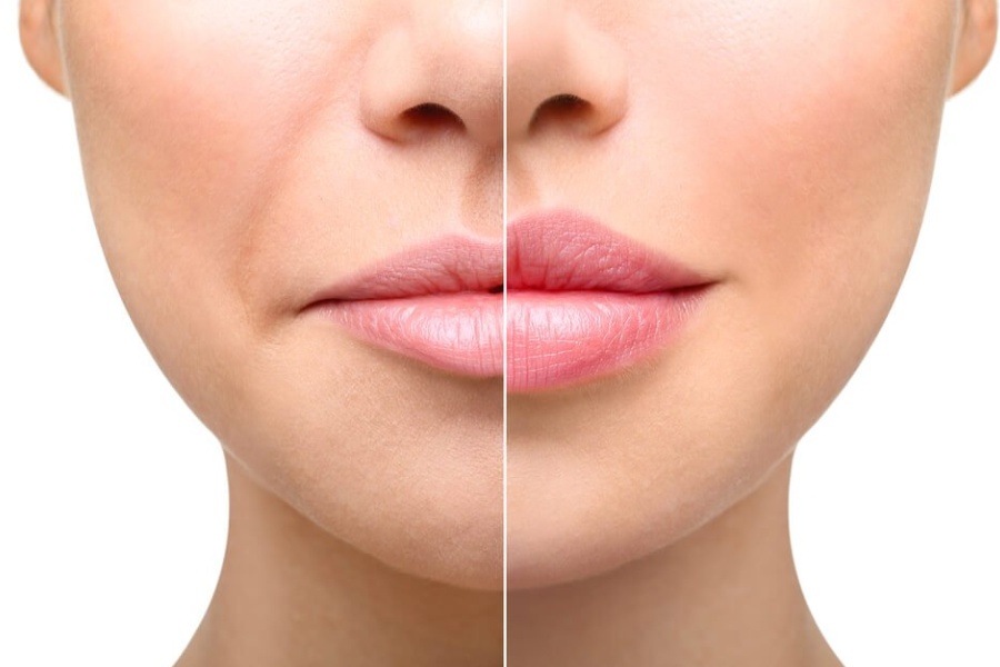 Tiêm filler môi thường giữ được khoảng 12 đến 18 tháng tùy thuộc vào cơ địa và cách filler hấp thụ