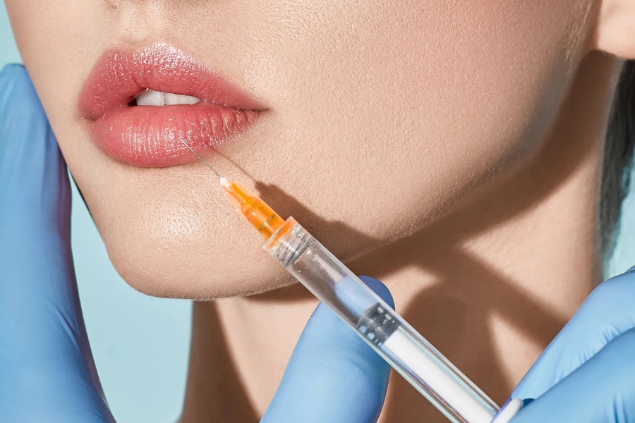 Bơm môi filler là phương pháp thẩm mỹ không phẫu thuật, đưa chất làm đầy vào da môi