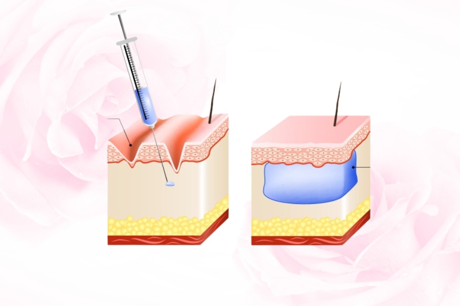 Tiêm filler vùng kín ở môi lớn giúp cân chỉnh kích thước môi lớn và môi bé hài hòa