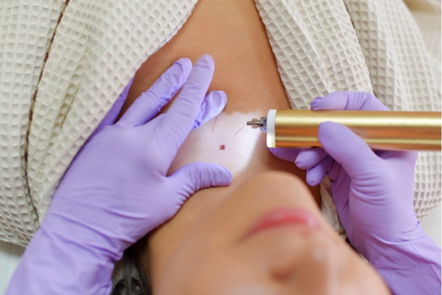 Phương pháp đốt điện tẩy nốt ruồi