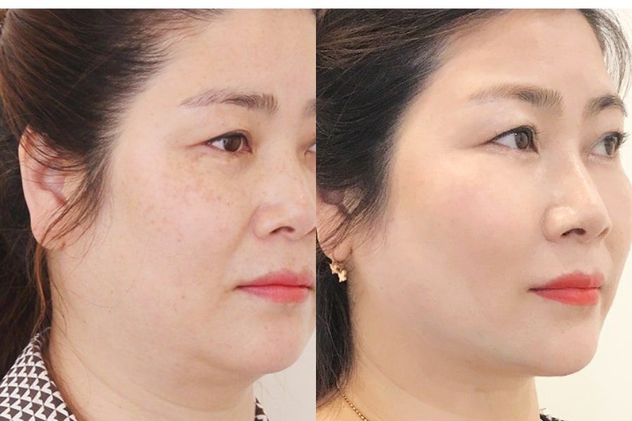 Hướng dẫn cách chăm sóc sau khi nâng gò má