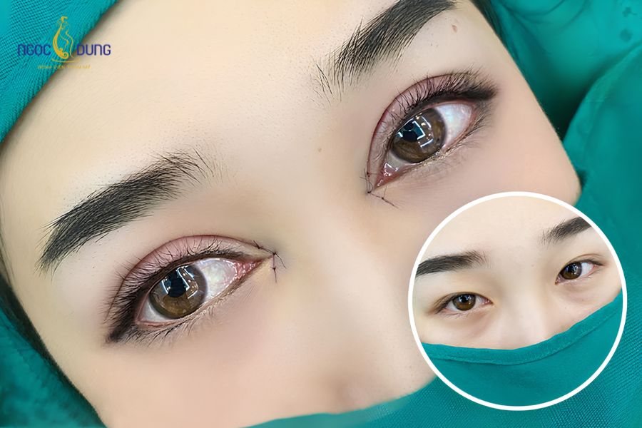 Mở góc mắt là gì? Ưu nhược điểm của cắt mí mở hốc mắt 12 Vùng da khóe mắt rất nhạy cảm, đòi hỏi kỹ thuật khâu đóng vết thương tỉ mỉ và chế độ chăm sóc kỹ càng