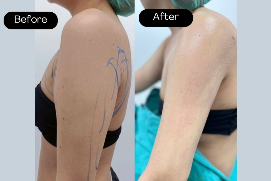 Discernible change after brachioplasty at Ngoc Dung