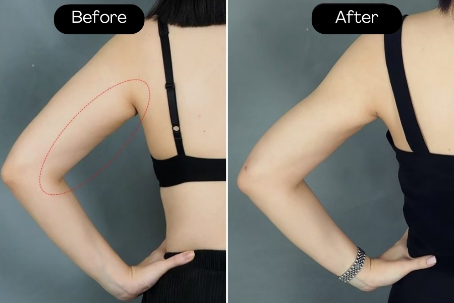 Thinner biceps after brachioplasty at Ngoc Dung Aesthetic Hospital