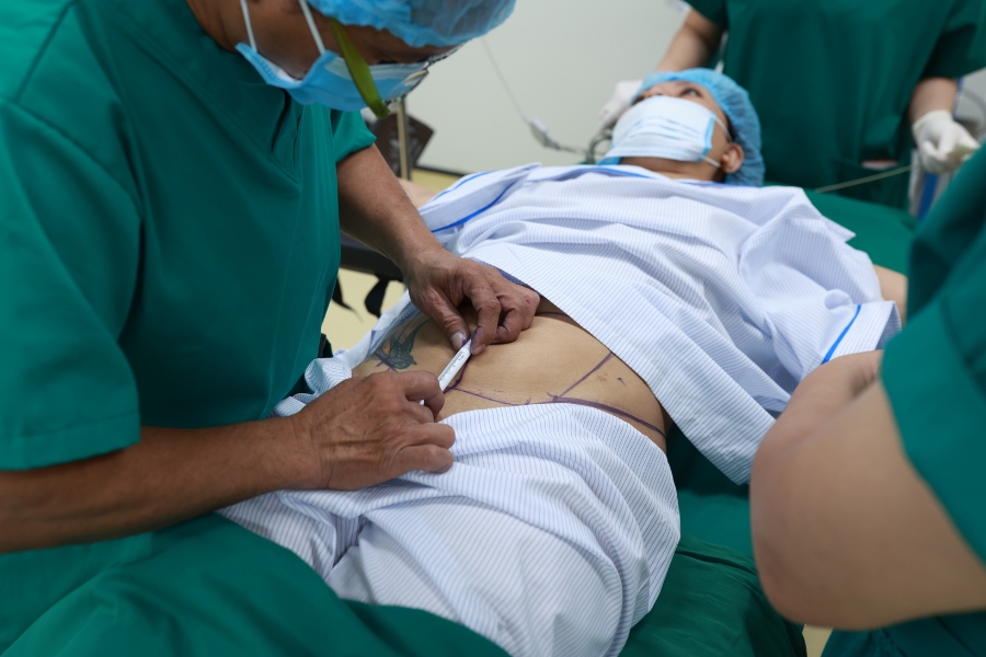 full-body liposuction service