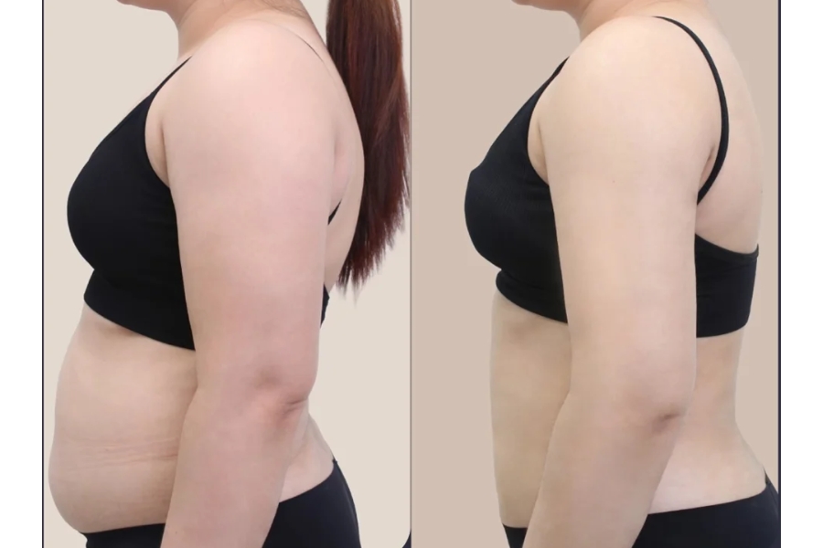 The result after full body liposuction