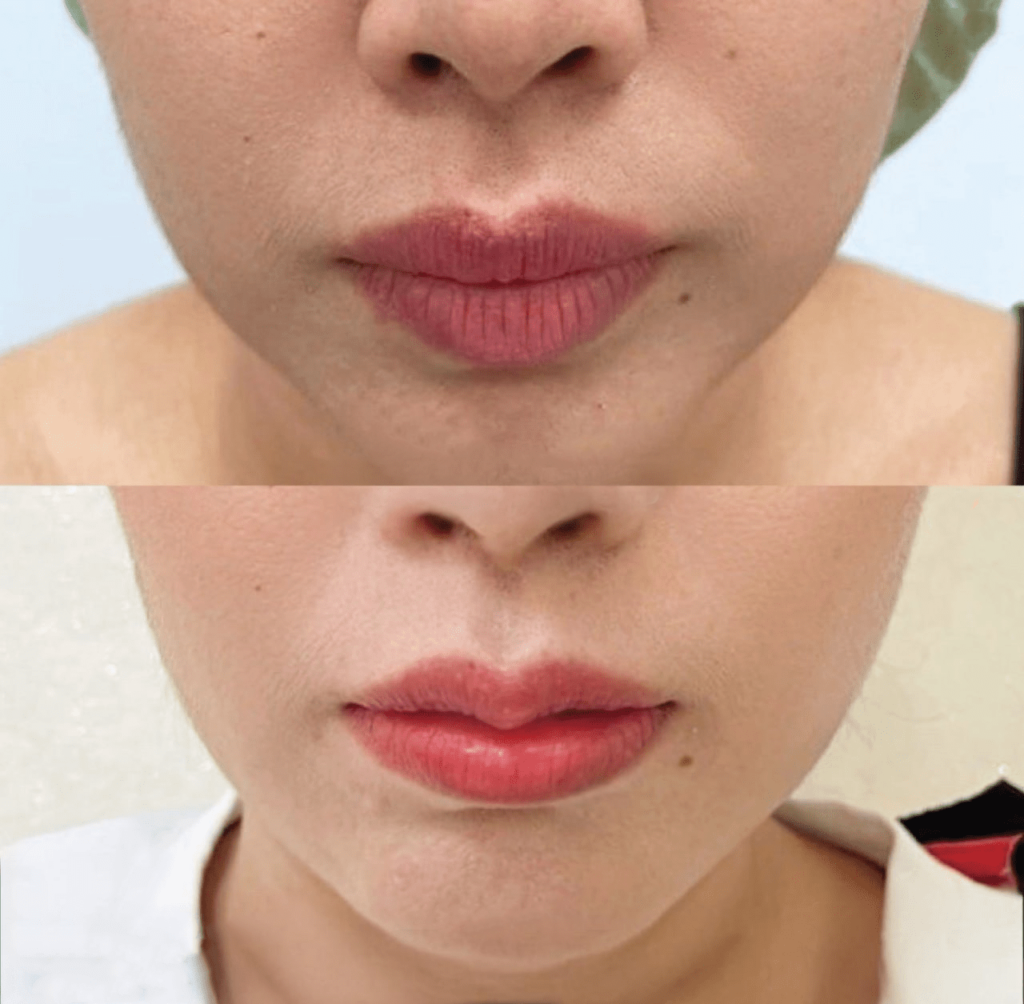 Result of cupid’s bow surgery after 1 month