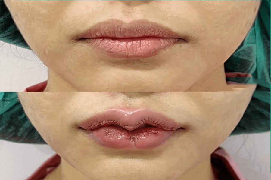 Image of cupid’s bow surgery after 1 day