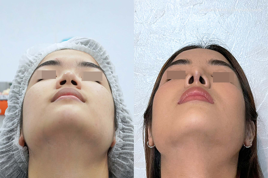 Transform appearance with Structure Rhinoplasty