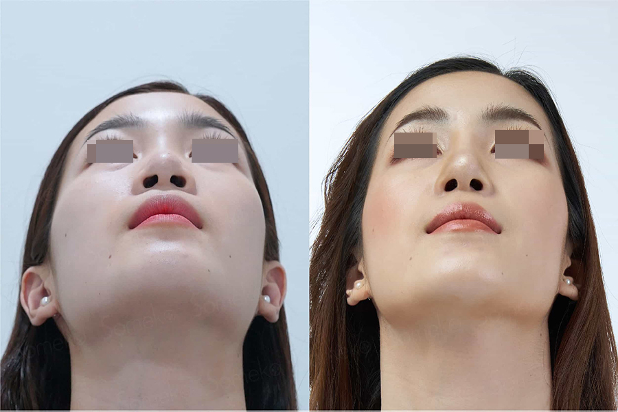 Cosmetic results after Structure rhinoplasty at Ngọc Dung Aesthetic