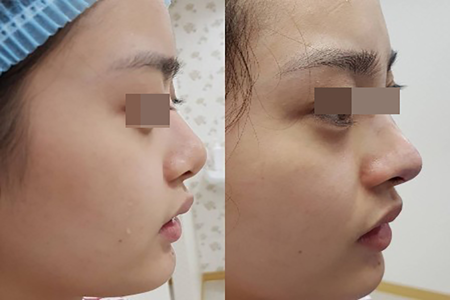 Aesthetic Results of Autologous Cartilage Rhinoplasty