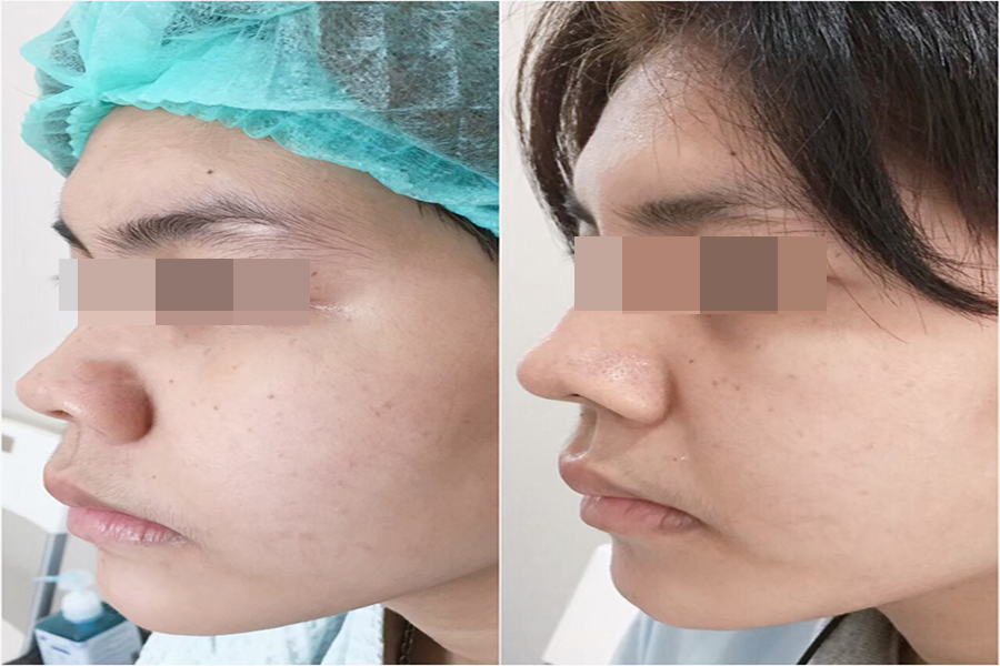 Stunning before and after rhinoplasty images with autologous cartilage