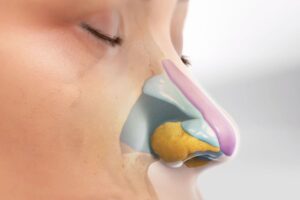 Overview of Autologous Cartilage Rhinoplasty Service