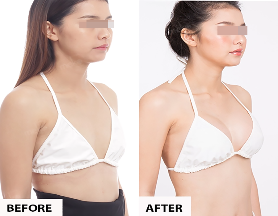 Effects of augmentation mammoplasty with AFG at Ngọc Dung Aesthetic Hospital