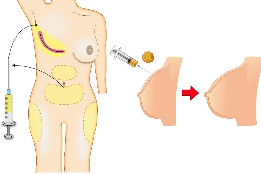 Overview of augmentation mammoplasty with AFG