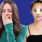 Sau nâng mũi có được ngáp không? Bao lâu thì được ngáp?