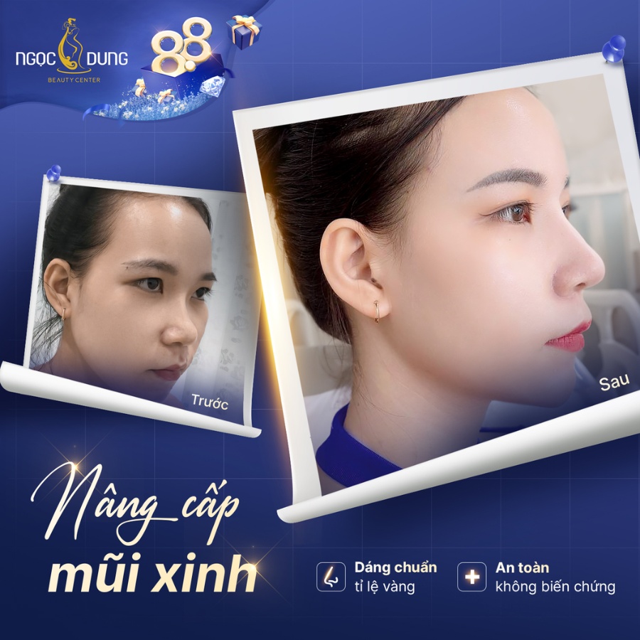 Hình ảnh mũi của khách hàng sau khi nâng mũi tại Bệnh viện thẩm mỹ Ngọc Dung