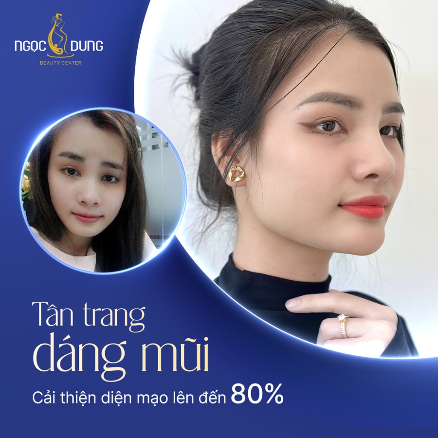 Kết quả nâng mũi sụn nhân tạo tại Bệnh viện thẩm mỹ Ngọc Dung