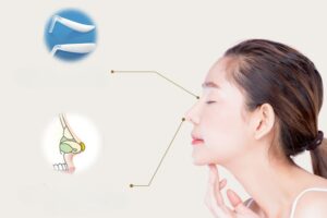 Nâng mũi sụn nhân tạo là gì? Giá bao nhiêu? Vĩnh viễn không?