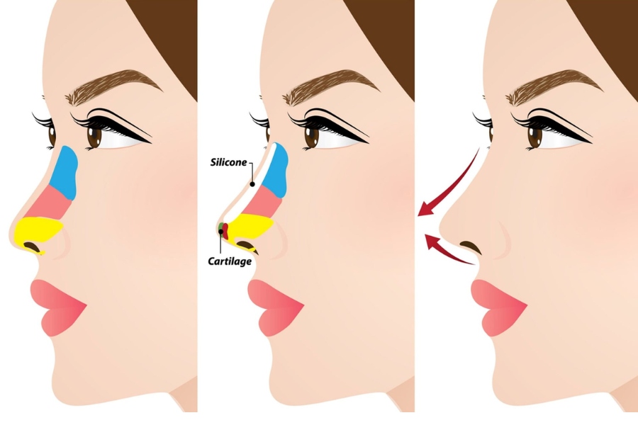 Nâng mũi sụn nhân tạo là một phương pháp thẩm mỹ nhằm cải thiện hình dáng và cấu trúc của mũi bằng cách sử dụng sụn nhân tạo.