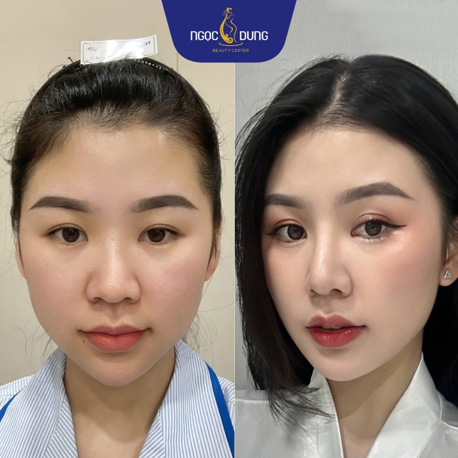 Kết quả nâng mũi tại Bệnh viện thẩm mỹ Ngọc Dung