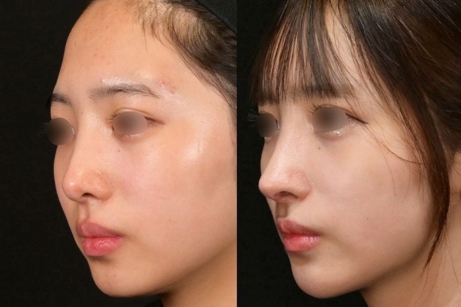 Hình ảnh nâng mũi sụn nhân tạo Hàn Quốc cải thiện các khuyết điểm mũi