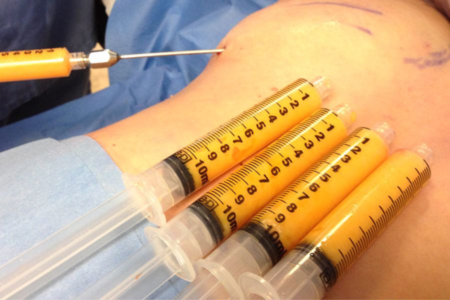 Cấy mỡ tự thân hạn chế nguy cơ dị ứng, bởi không sử dụng các vật liệu nhân tạo 