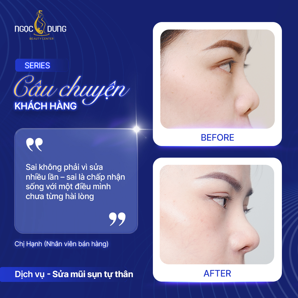 Chị Hạnh - Hạnh phúc sau khi sửa mũi sụn tự thân 3 CHI HANH